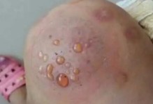拔罐水泡的处理方法（科学有效的拔罐水泡护理技巧）